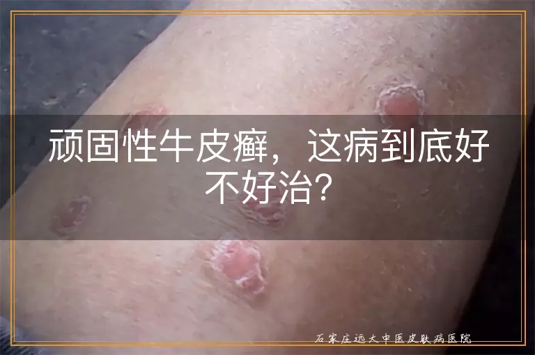 顽固性牛皮癣，这病到底好不好治？