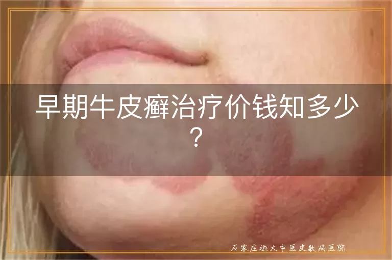 早期牛皮癣治疗价钱知多少？