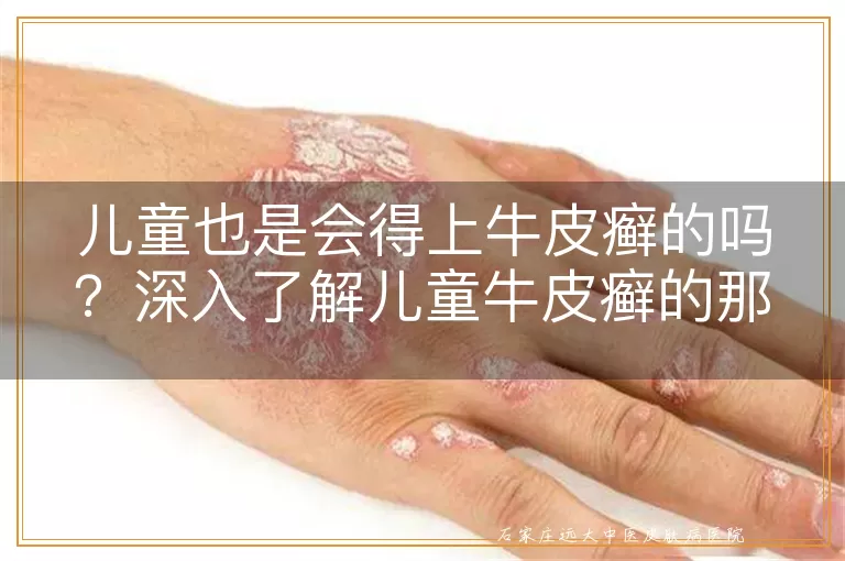 儿童也是会得上牛皮癣的吗？深入了解儿童牛皮癣的那些事儿