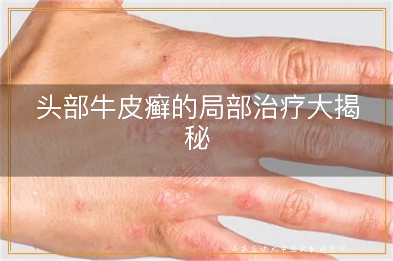 头部牛皮癣的局部治疗大揭秘
