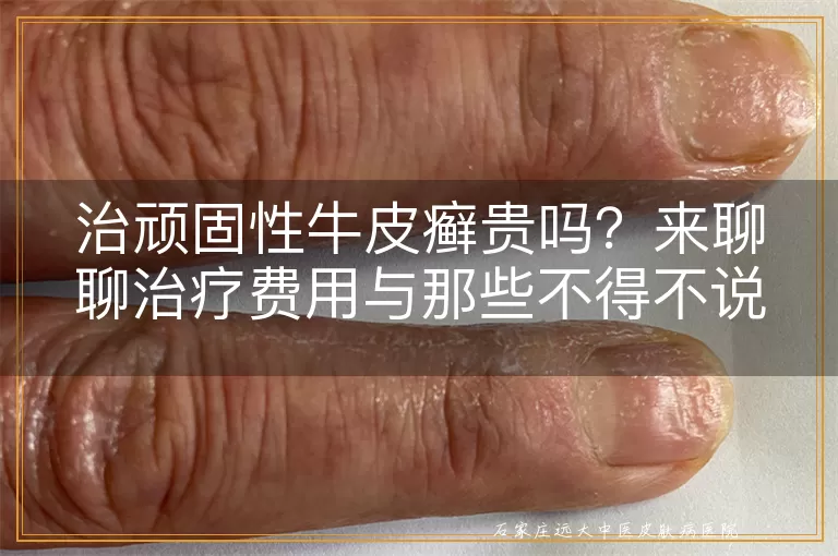 治顽固性牛皮癣贵吗？来聊聊治疗费用与那些不得不说的事儿