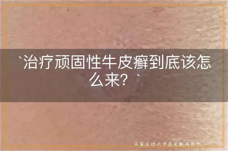 治疗顽固性牛皮癣到底该怎么来？