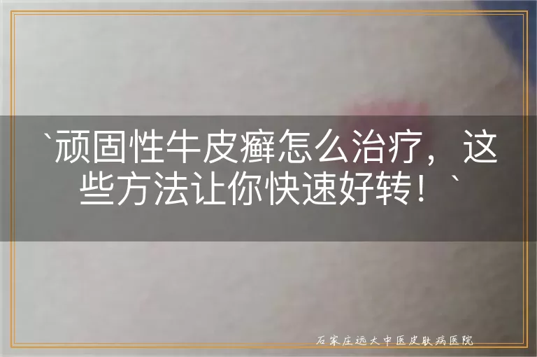 顽固性牛皮癣怎么治疗，这些方法让你快速好转！