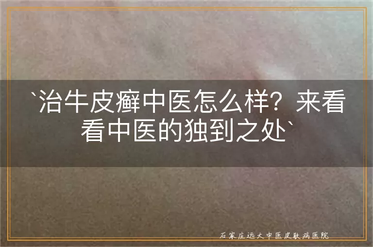 治牛皮癣中医怎么样？来看看中医的独到之处