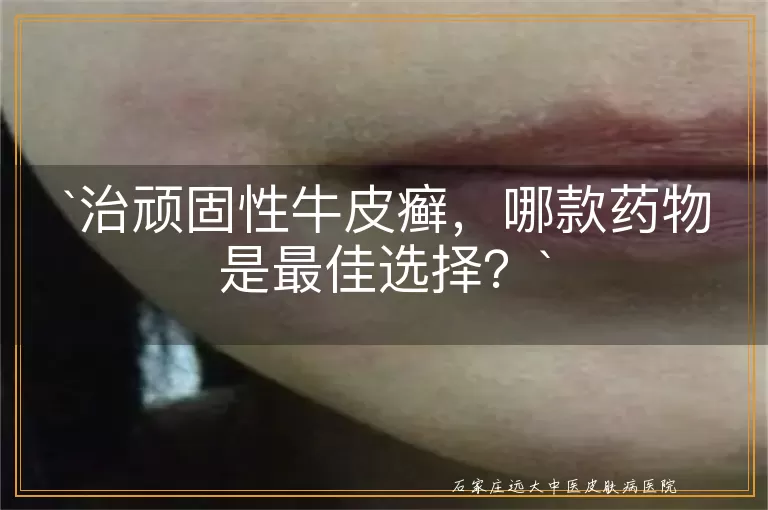 治顽固性牛皮癣,哪款药物是最佳选择?