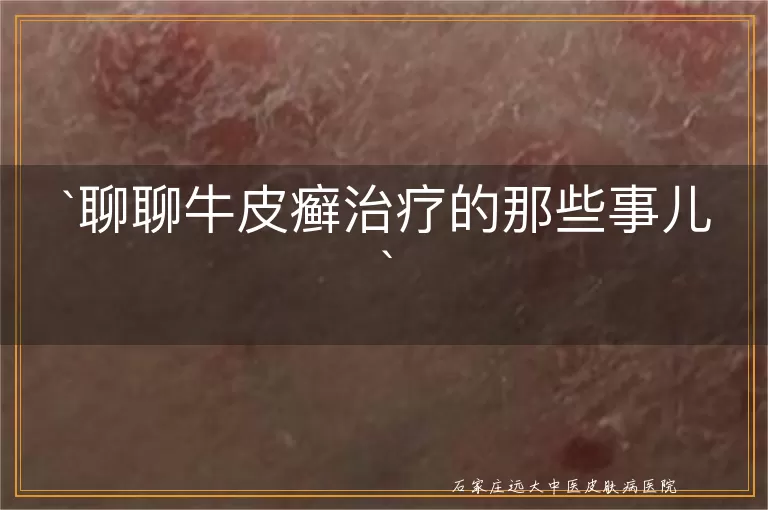 聊聊牛皮癣治疗的那些事儿