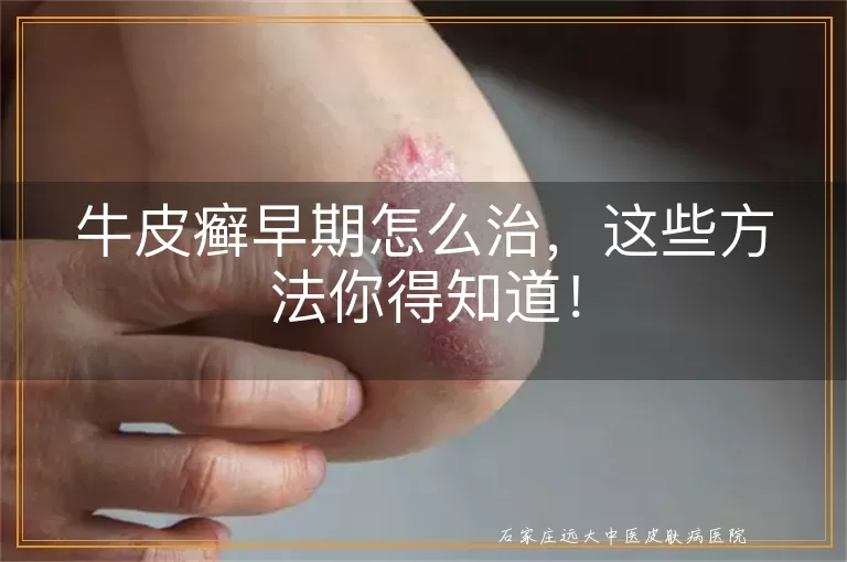 牛皮癣早期怎么治,这些方法你得知道!