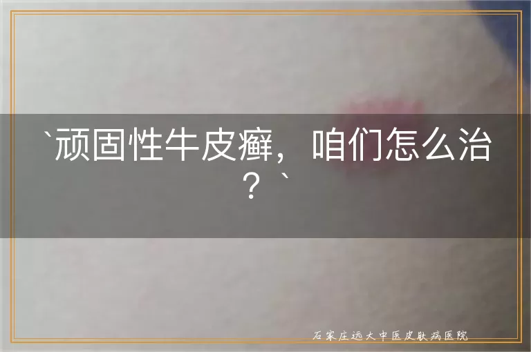 顽固性牛皮癣,咱们怎么治?