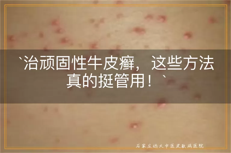 治顽固性牛皮癣，这些方法真的挺管用！