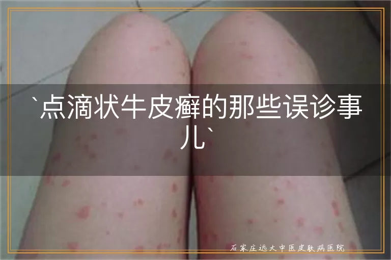 点滴状牛皮癣的那些误诊事儿