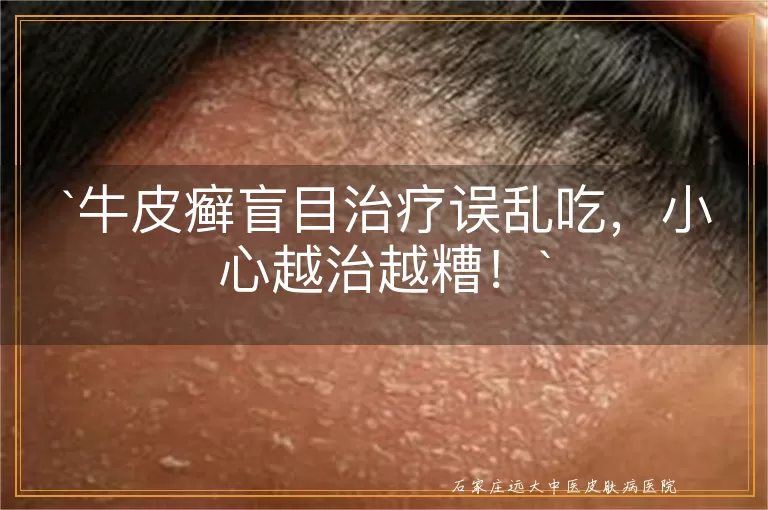牛皮癣盲目治疗误乱吃，小心越治越糟！