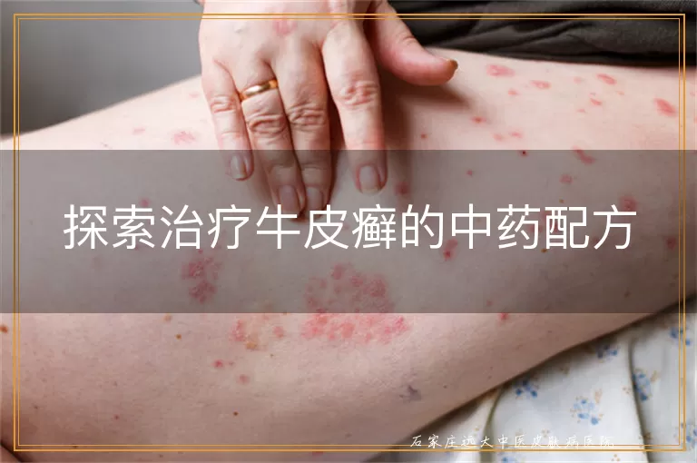 探索治疗牛皮癣的中药配方