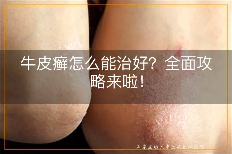 牛皮癣怎么能治好？全面攻略来啦！