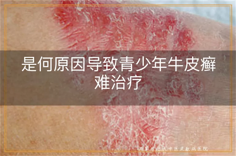 是何原因导致青少年牛皮癣难治疗