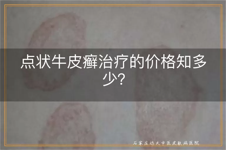 点状牛皮癣治疗的价格知多少?