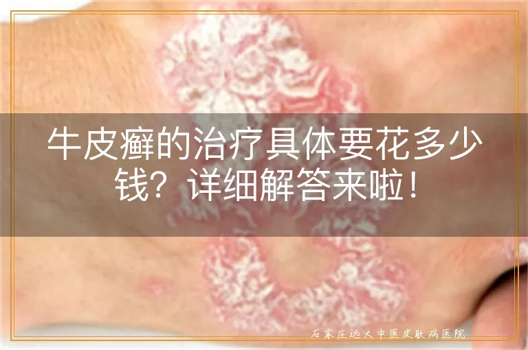 牛皮癣的治疗具体要花多少钱?详细解答来啦!