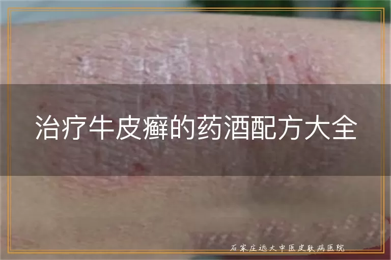治疗牛皮癣的药酒配方大全
