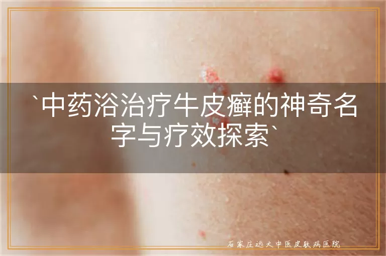 中药浴治疗牛皮癣的神奇名字与疗效探索
