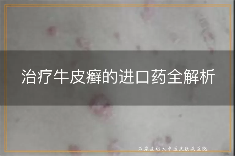 治疗牛皮癣的进口药全解析