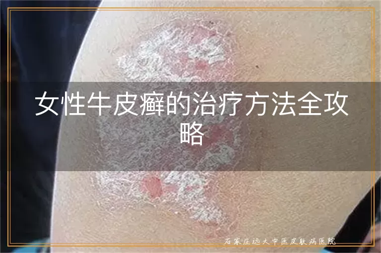 女性牛皮癣的治疗方法全攻略