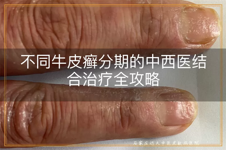 不同牛皮癣分期的中西医结合治疗全攻略