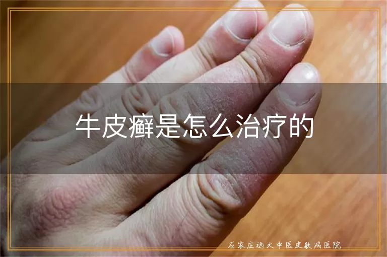 牛皮癣是怎么治疗的