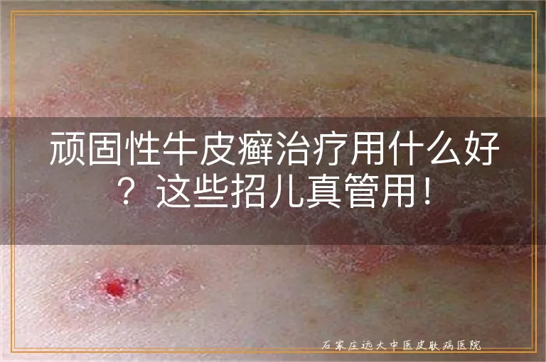 顽固性牛皮癣治疗用什么好？这些招儿真管用！