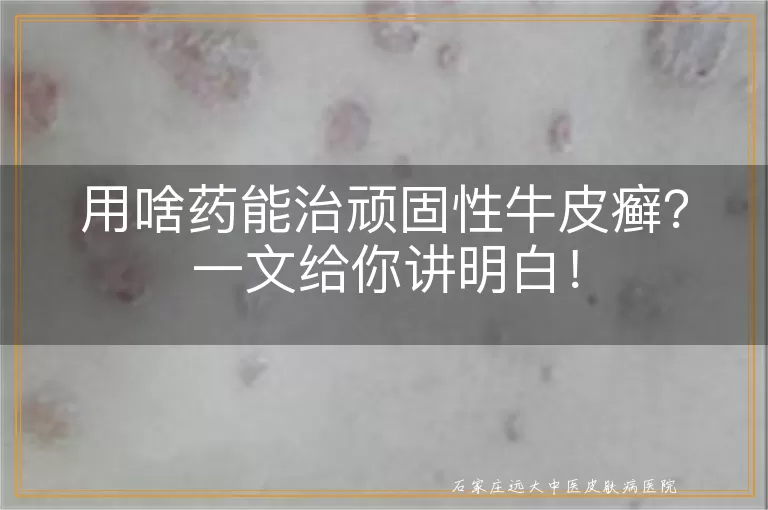 用啥药能治顽固性牛皮癣?一文给你讲明白!