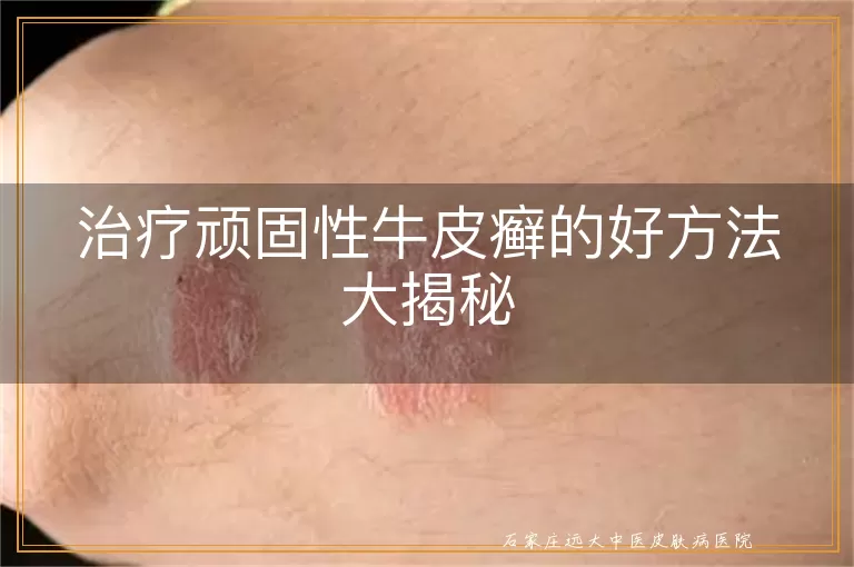 治疗顽固性牛皮癣的好方法大揭秘