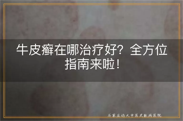 牛皮癣在哪治疗好？全方位指南来啦！