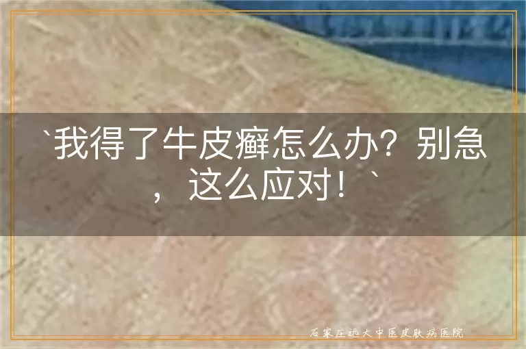 我得了牛皮癣怎么办？别急，这么应对！