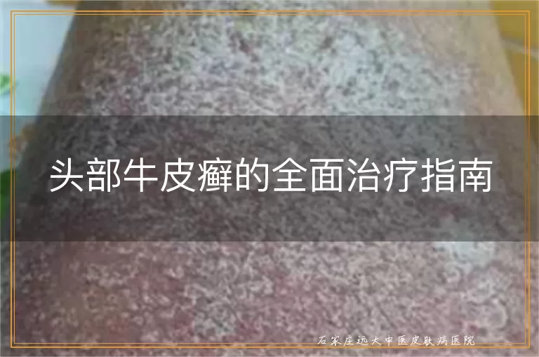 头部牛皮癣的全面治疗指南
