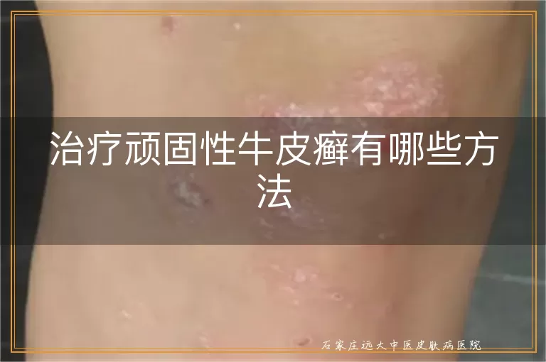 治疗顽固性牛皮癣有哪些方法