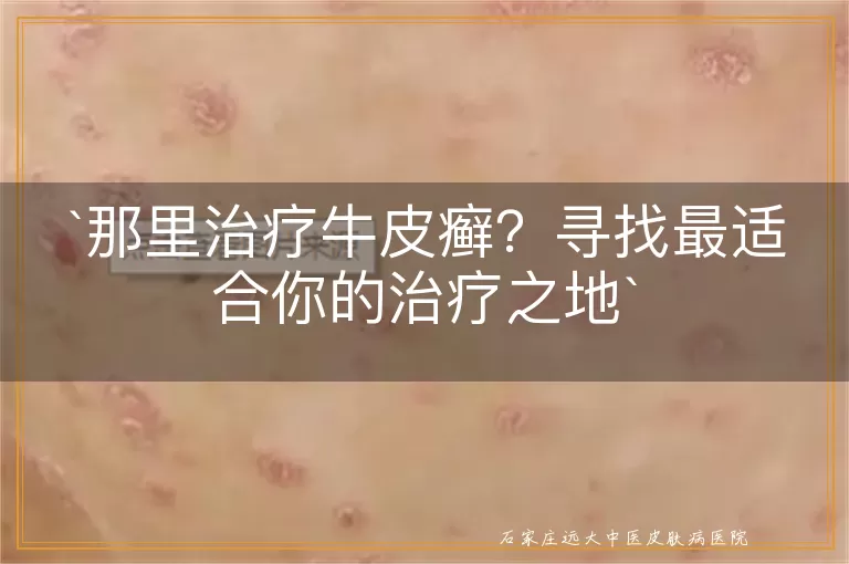 那里治疗牛皮癣？寻找最适合你的治疗之地