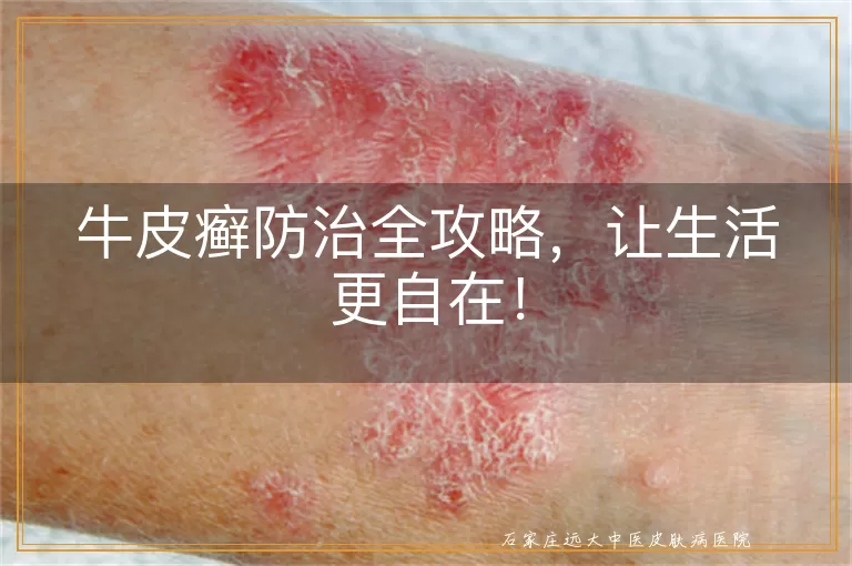 牛皮癣防治全攻略，让生活更自在！