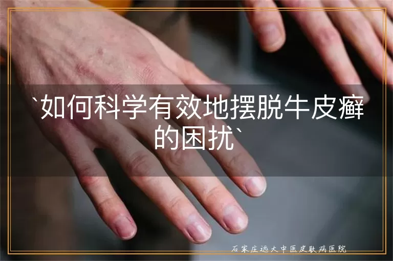 如何科学有效地摆脱牛皮癣的困扰