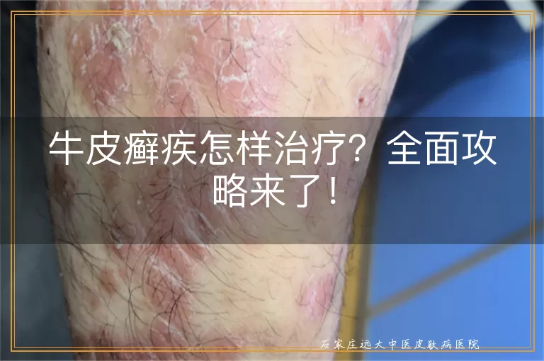 牛皮癣疾怎样治疗？全面攻略来了！