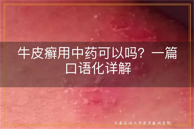 牛皮癣用中药可以吗？一篇口语化详解
