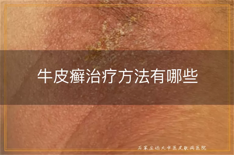 牛皮癣治疗方法有哪些