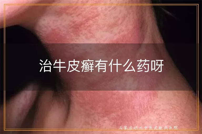 治牛皮癣有什么药呀