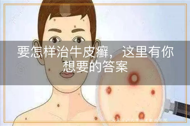 要怎样治牛皮癣,这里有你想要的答案