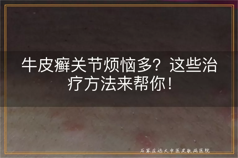 牛皮癣关节烦恼多？这些治疗方法来帮你！
