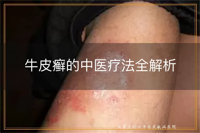 牛皮癣的中医疗法全解析