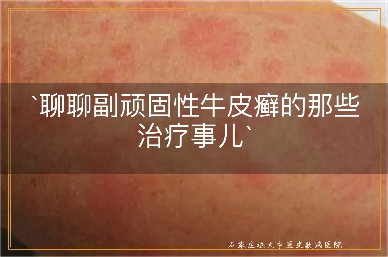 聊聊副顽固性牛皮癣的那些治疗事儿