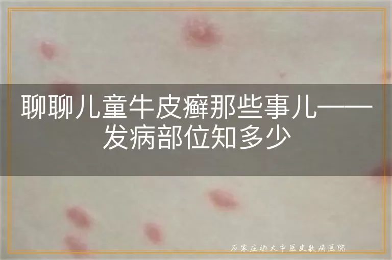 聊聊儿童牛皮癣那些事儿——发病部位知多少