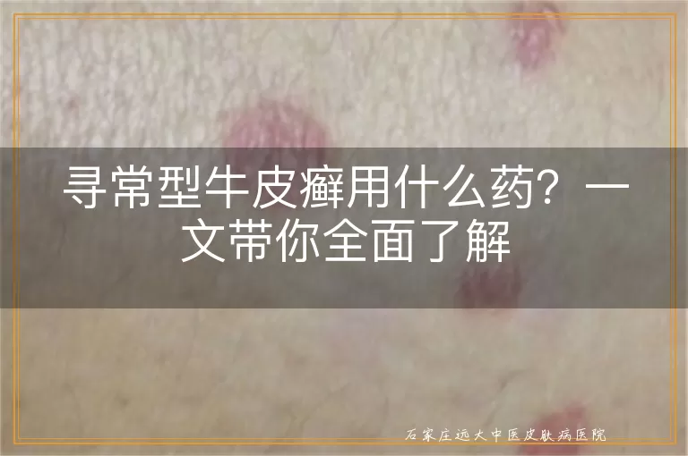 寻常型牛皮癣用什么药？一文带你全面了解