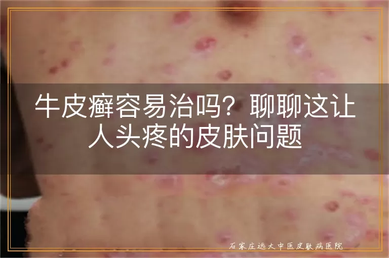 牛皮癣容易治吗？聊聊这让人头疼的皮肤问题