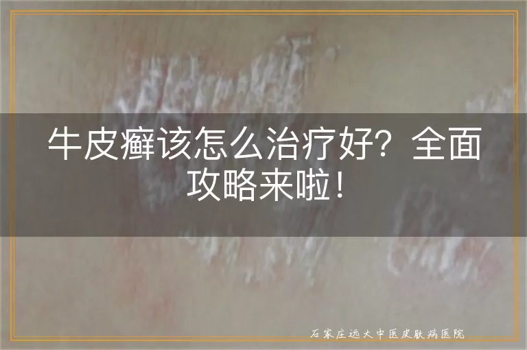 牛皮癣该怎么治疗好？全面攻略来啦！