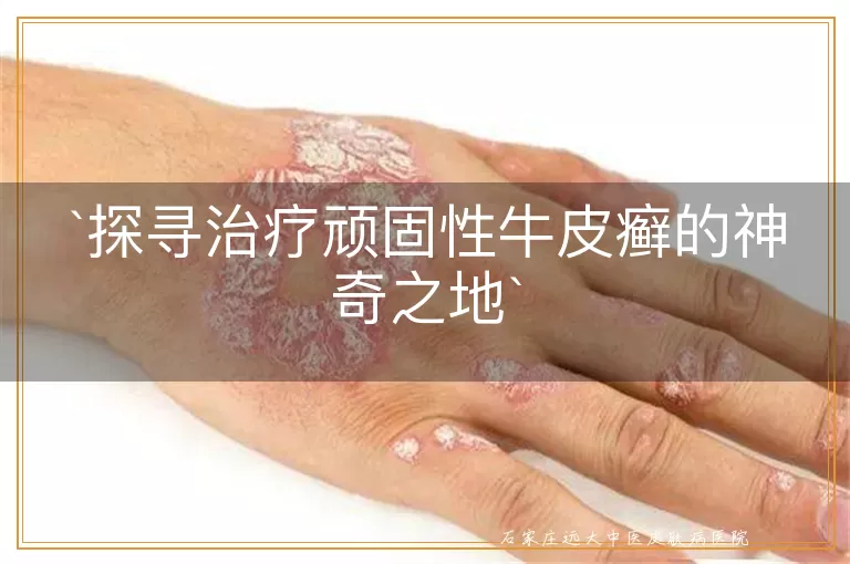 探寻治疗顽固性牛皮癣的神奇之地