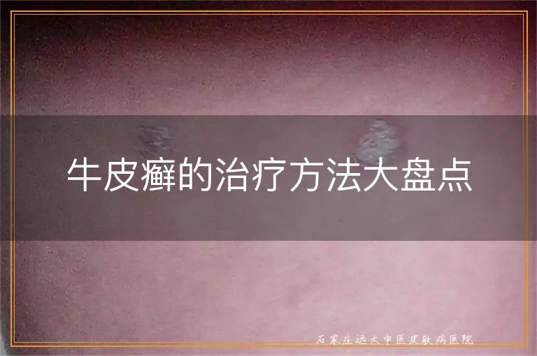 牛皮癣的治疗方法大盘点